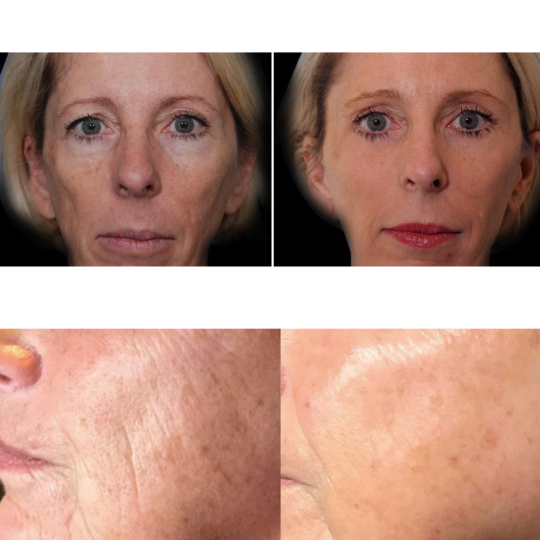 Metamorph8.5™ Golden Youth RF Microneedling Machine