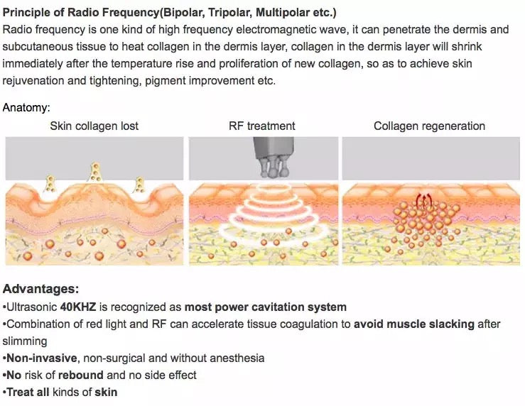 Principles of Radio Frequency Skin Tightening