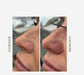 PicoPretty® Q-Switched ND-YAG Laser Machine