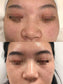 PicoPretty® Q-Switched ND-YAG Laser Machine