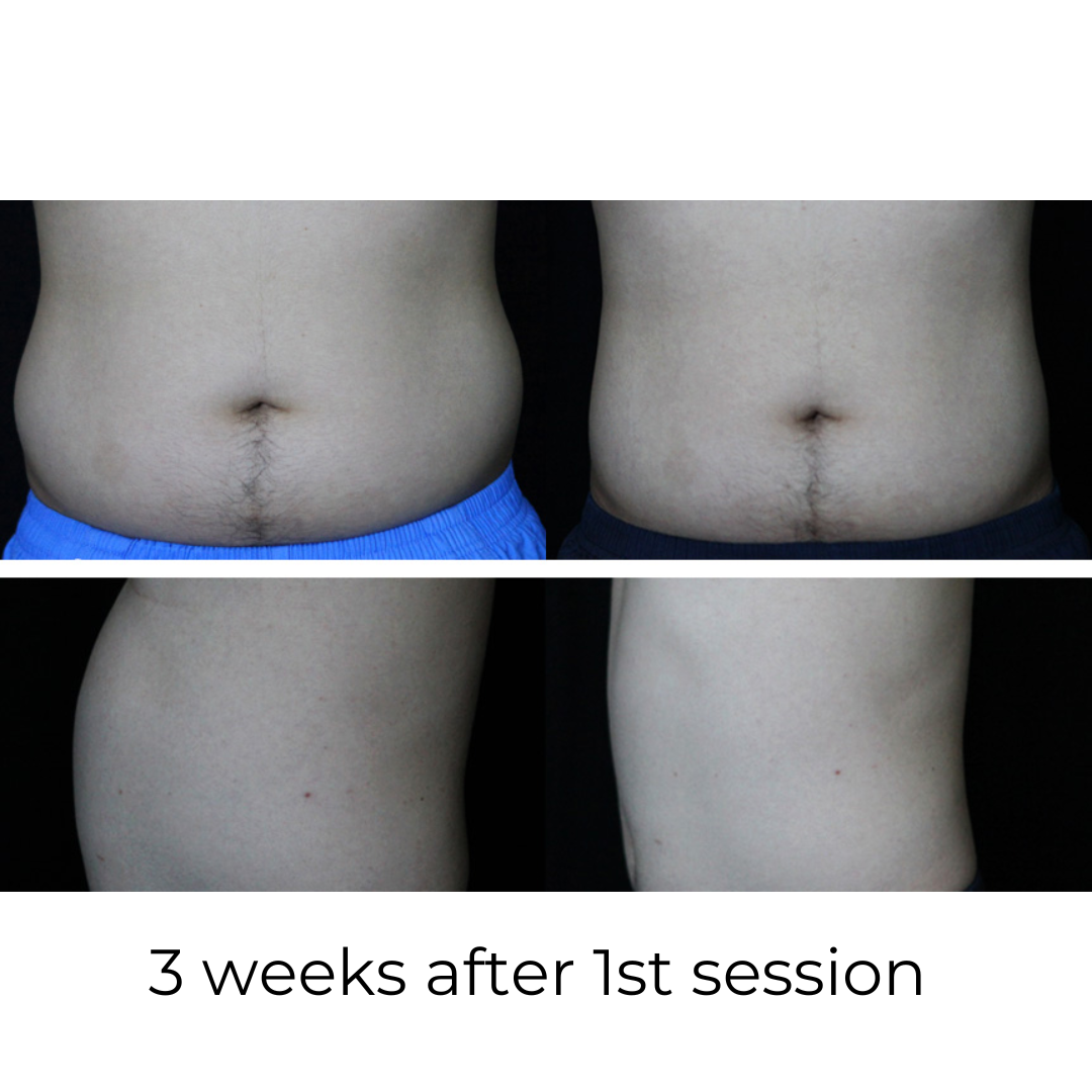 SculptAssure 1060nm Diode Laser Weight Loss Machine