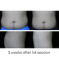 SculptAssure 1060nm Diode Laser Weight Loss Machine
