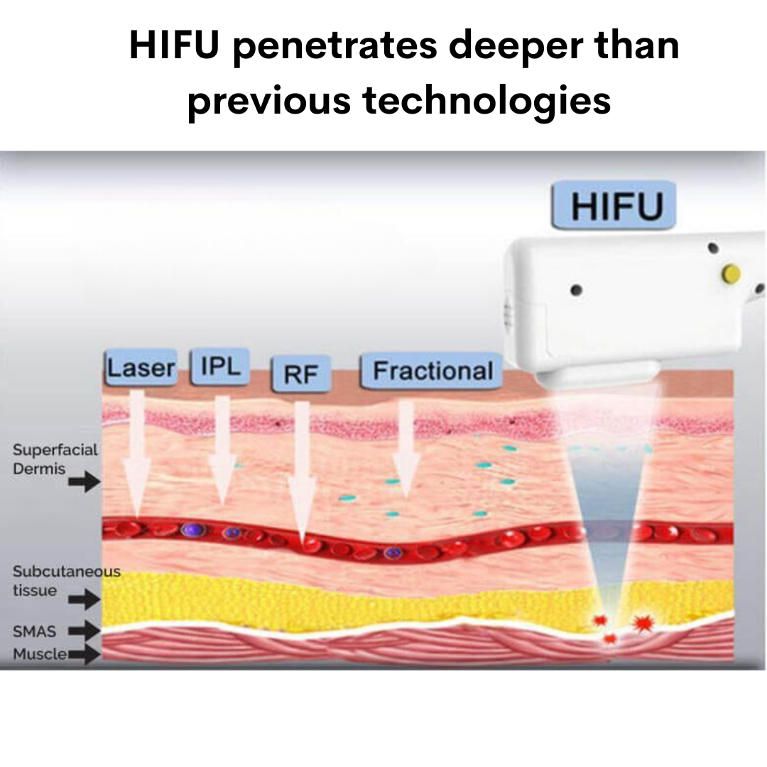 Cartucho de Reemplazo para Máquina HIFU de Elevación Facial 9D