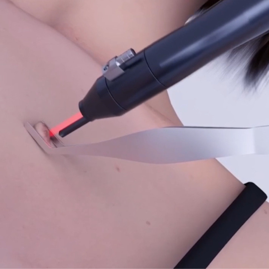 CarbonFrax™  Pro CO2 Fractional Laser