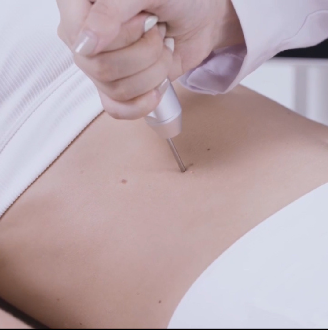 CarbonFrax™  Pro CO2 Fractional Laser