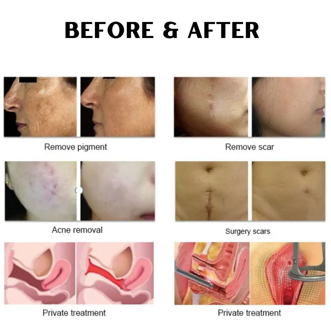 CarbonFrax™  Pro CO2 Fractional Laser