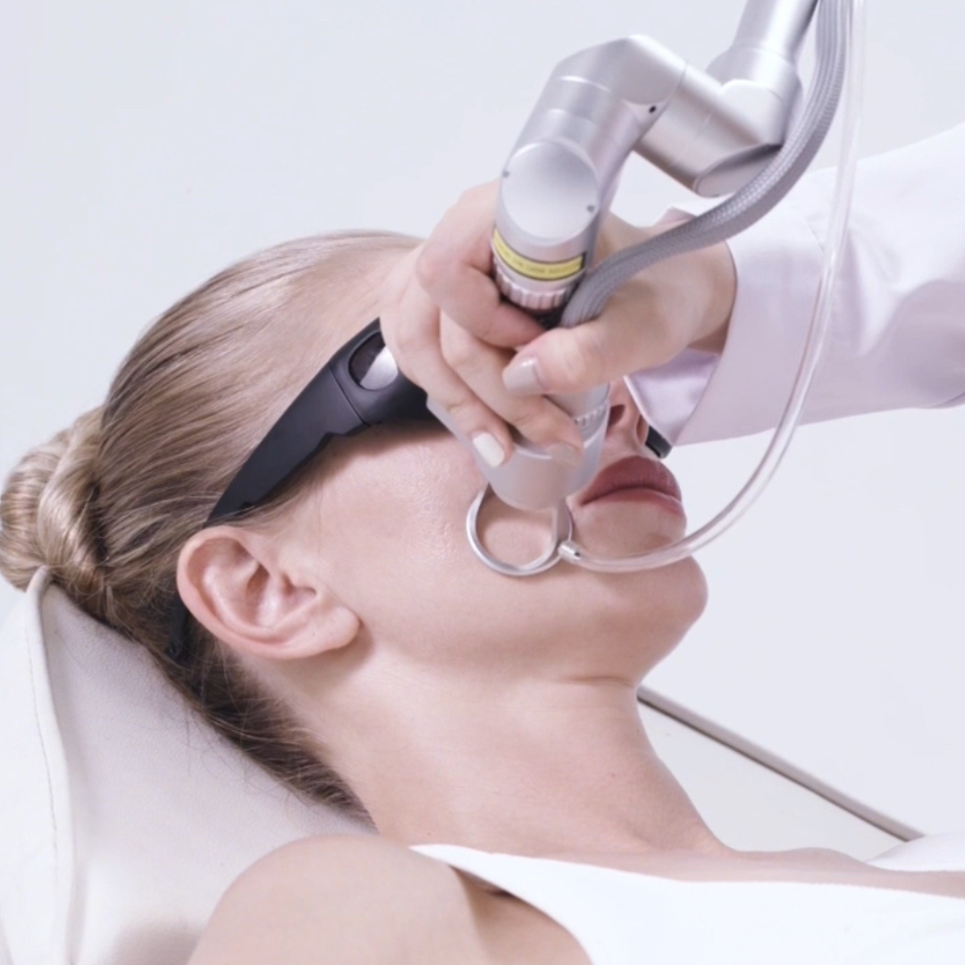 CarbonFrax™  Pro CO2 Fractional Laser