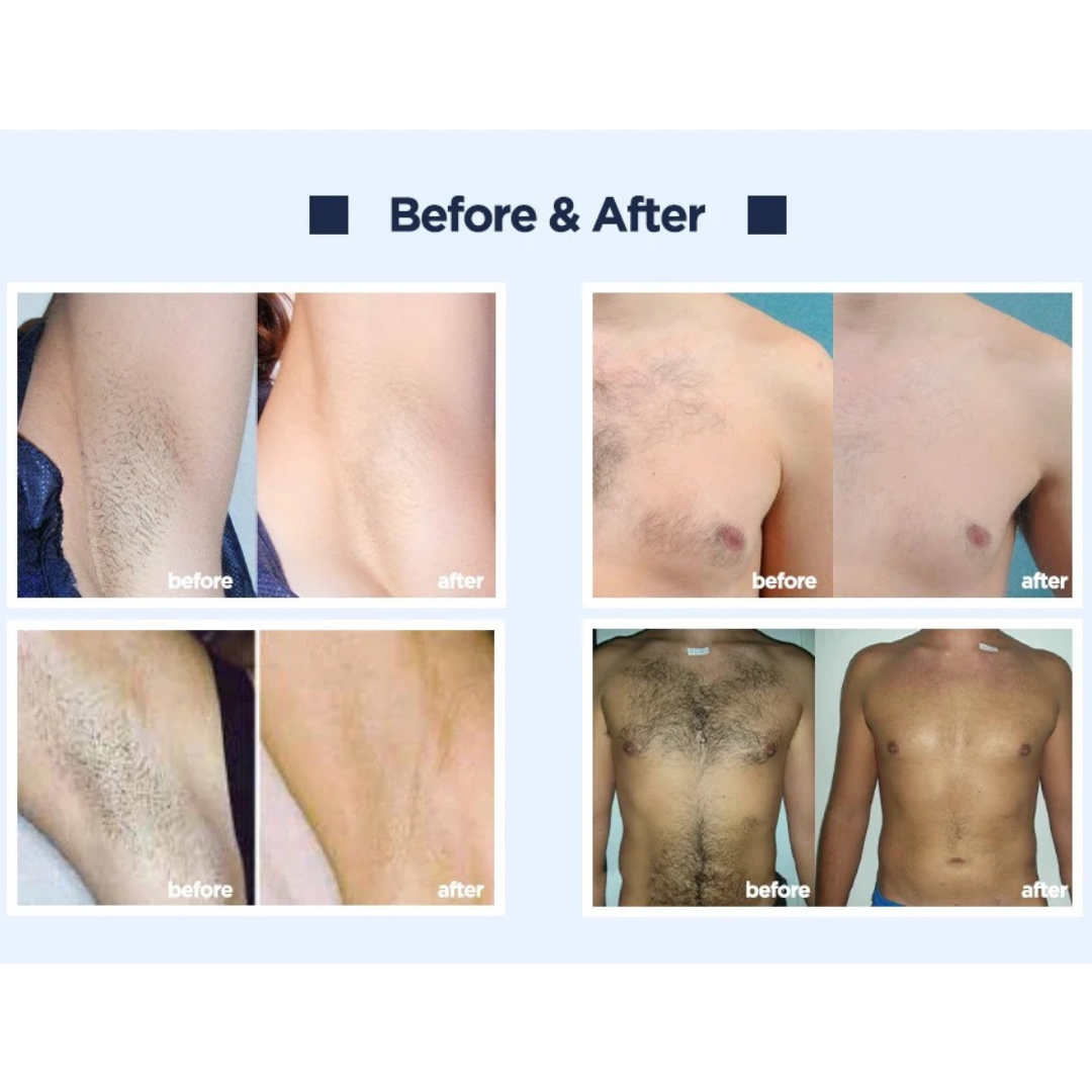 Machine d'épilation laser 4D Athena  