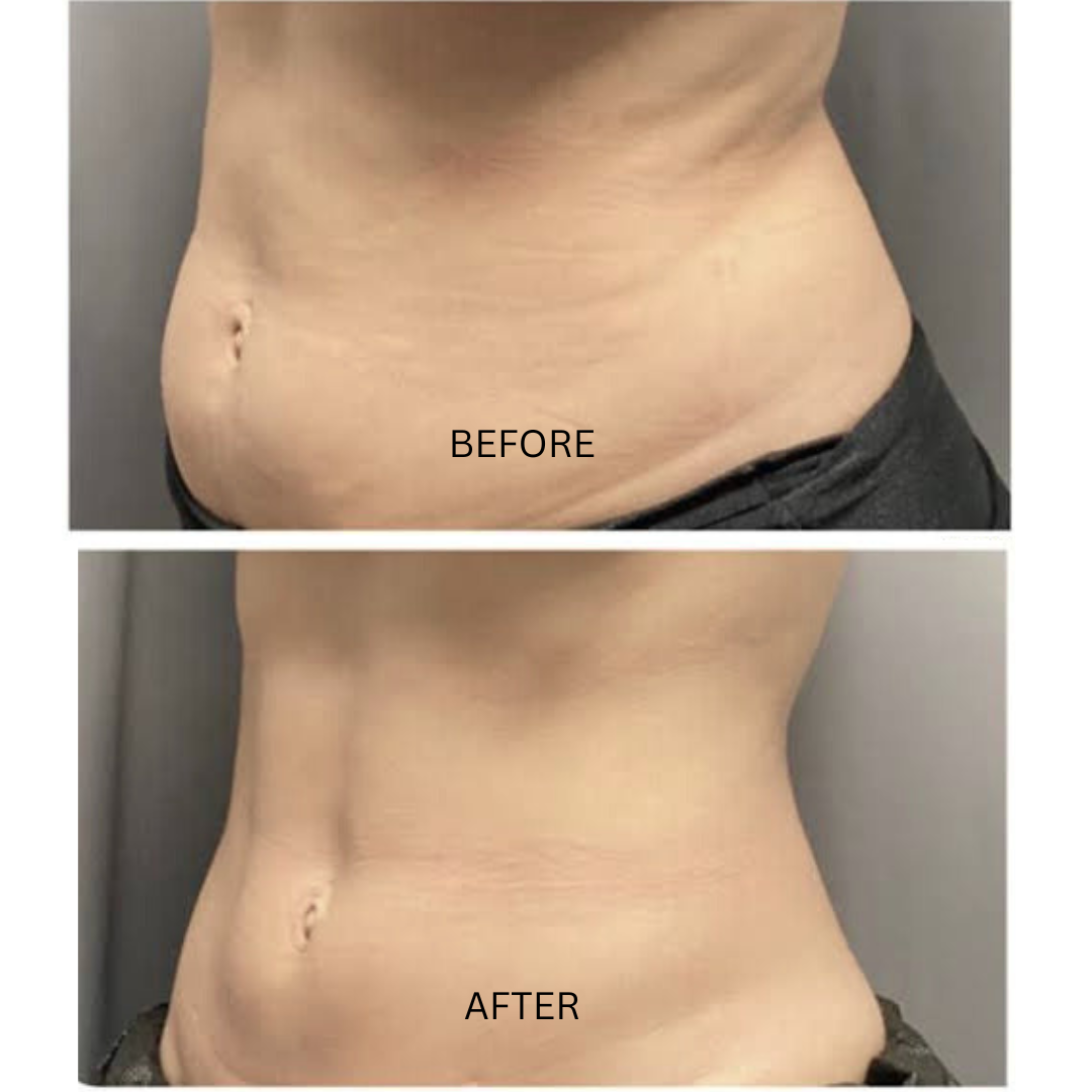 Professional PERFECT SHAPE® NEO PLUS (Body & Face)