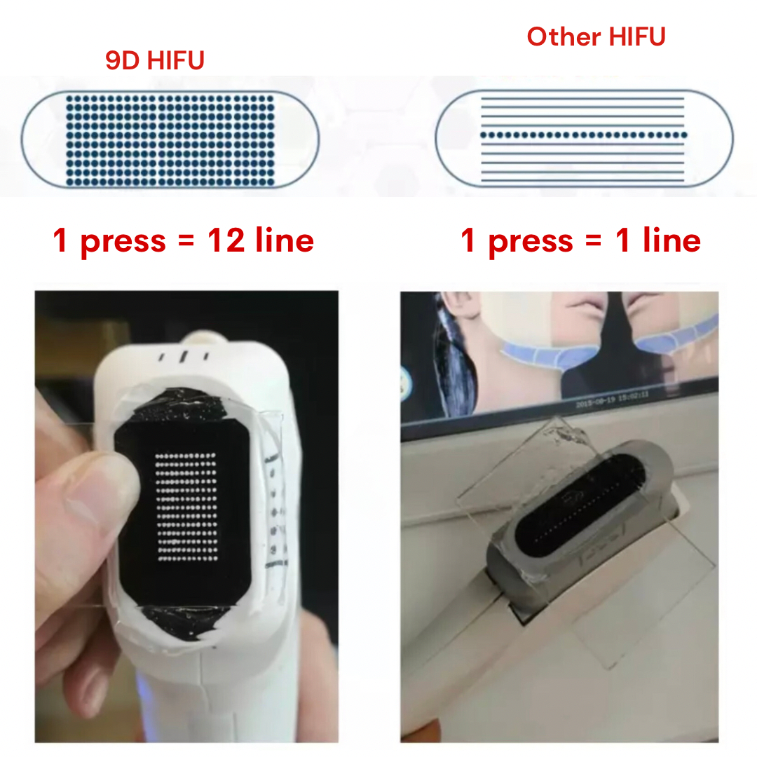 9D HIFU for Face | Non Surgical Cosmetic Procedure for Wrinkle 9D HIFU for Face | Non Surgical Cosmetic Procedure for Wrinkle