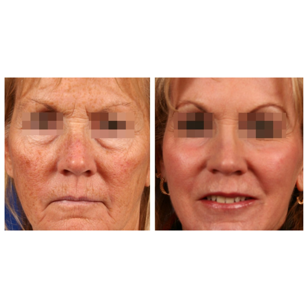 CoolPare™ LASER CO2 Fractionné EXPERT