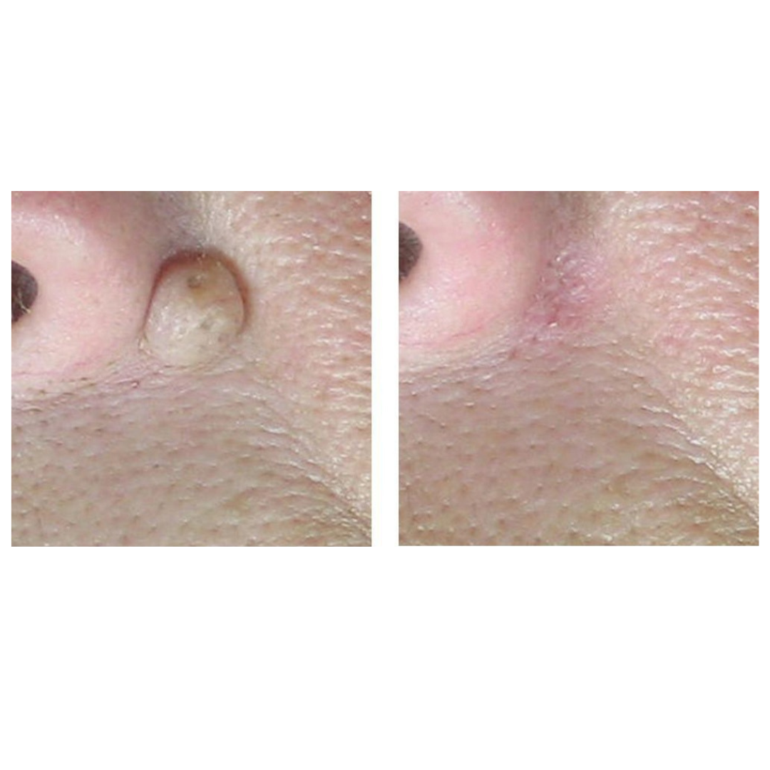 CoolPare™ LASER CO2 Fractionné EXPERT