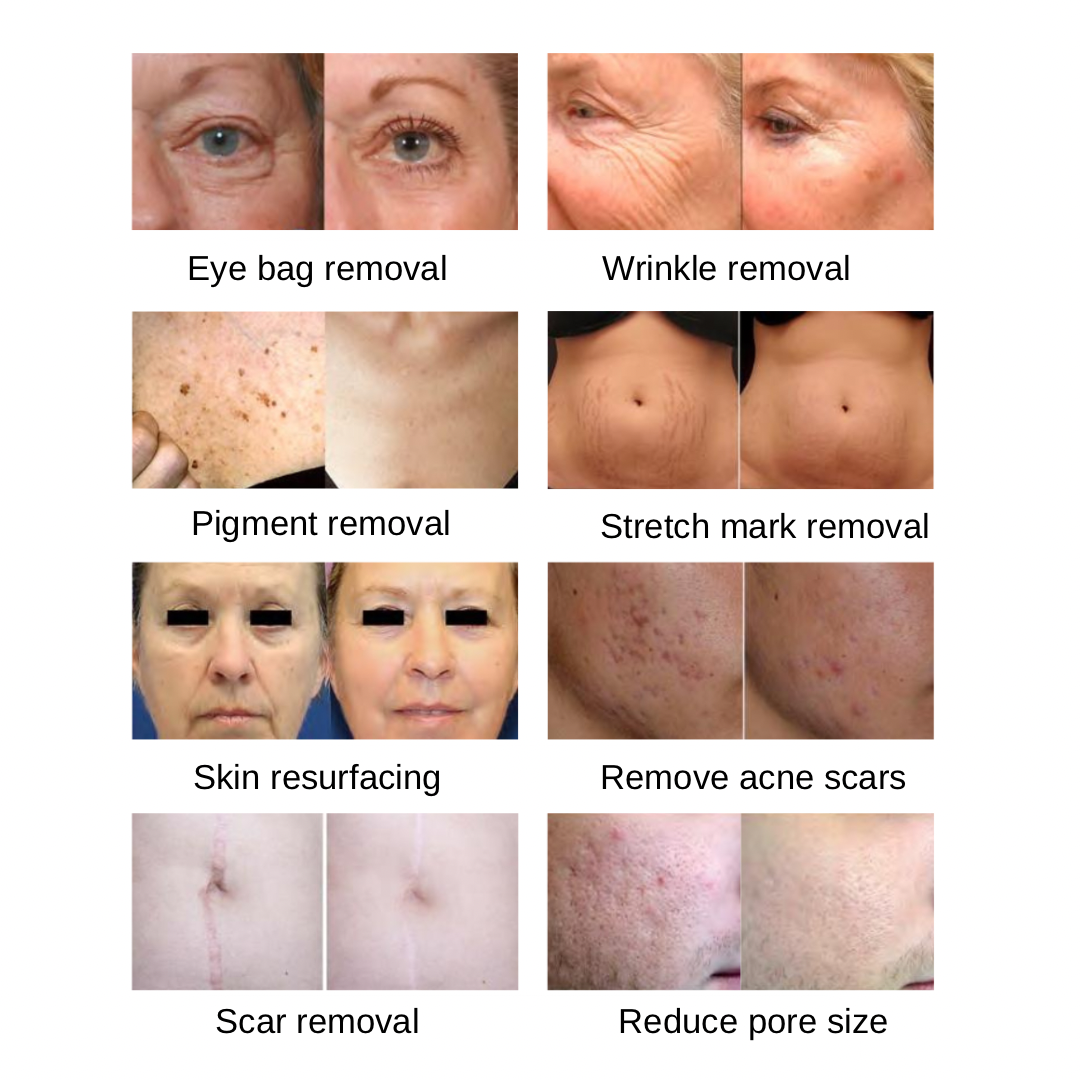 ReDerma™ Fractional CO2 Laser