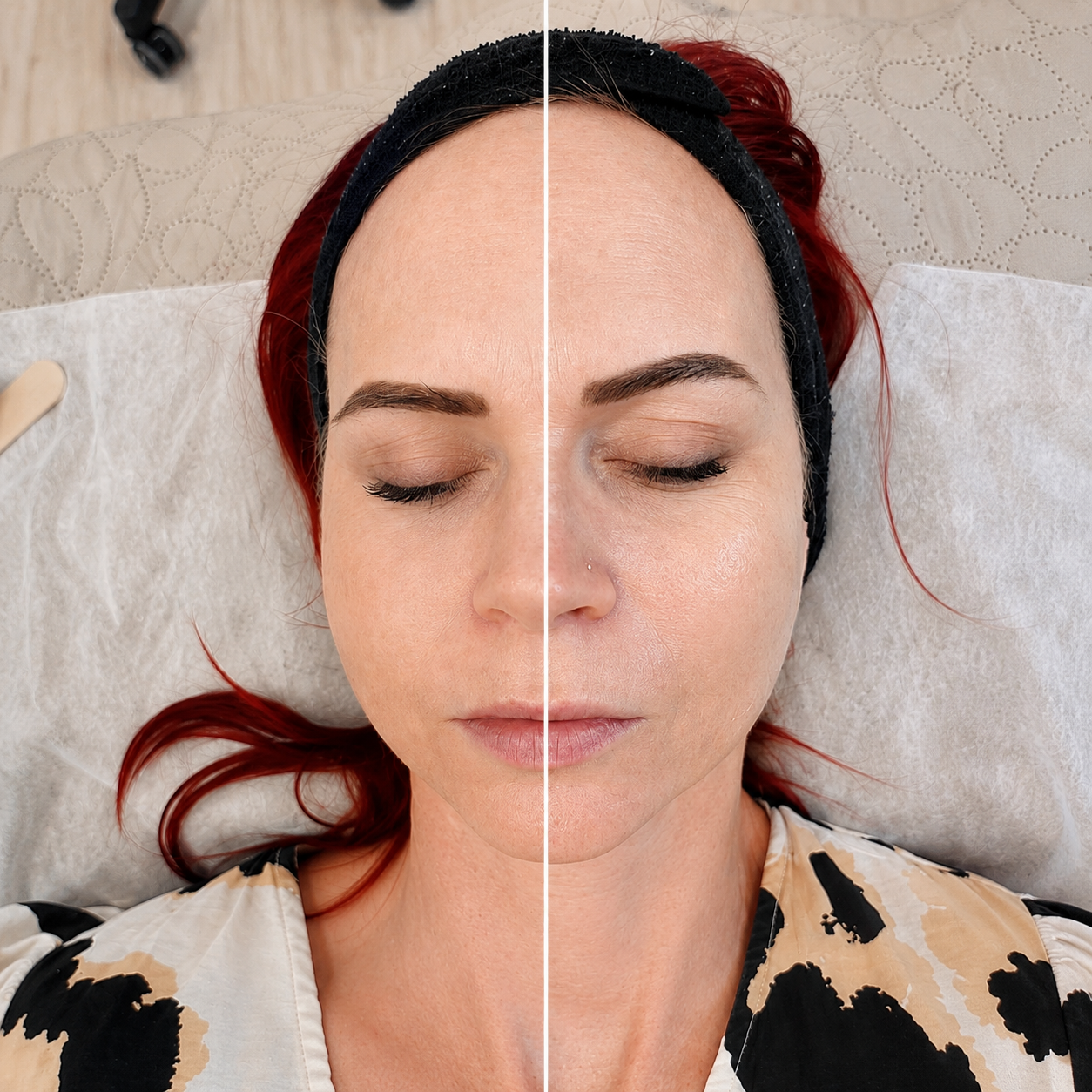 EliteLase ICE Platinum™ Stack Diode Laser (3 Wavelengths, 4 Spot Sizes, Skin Rejuvenation)