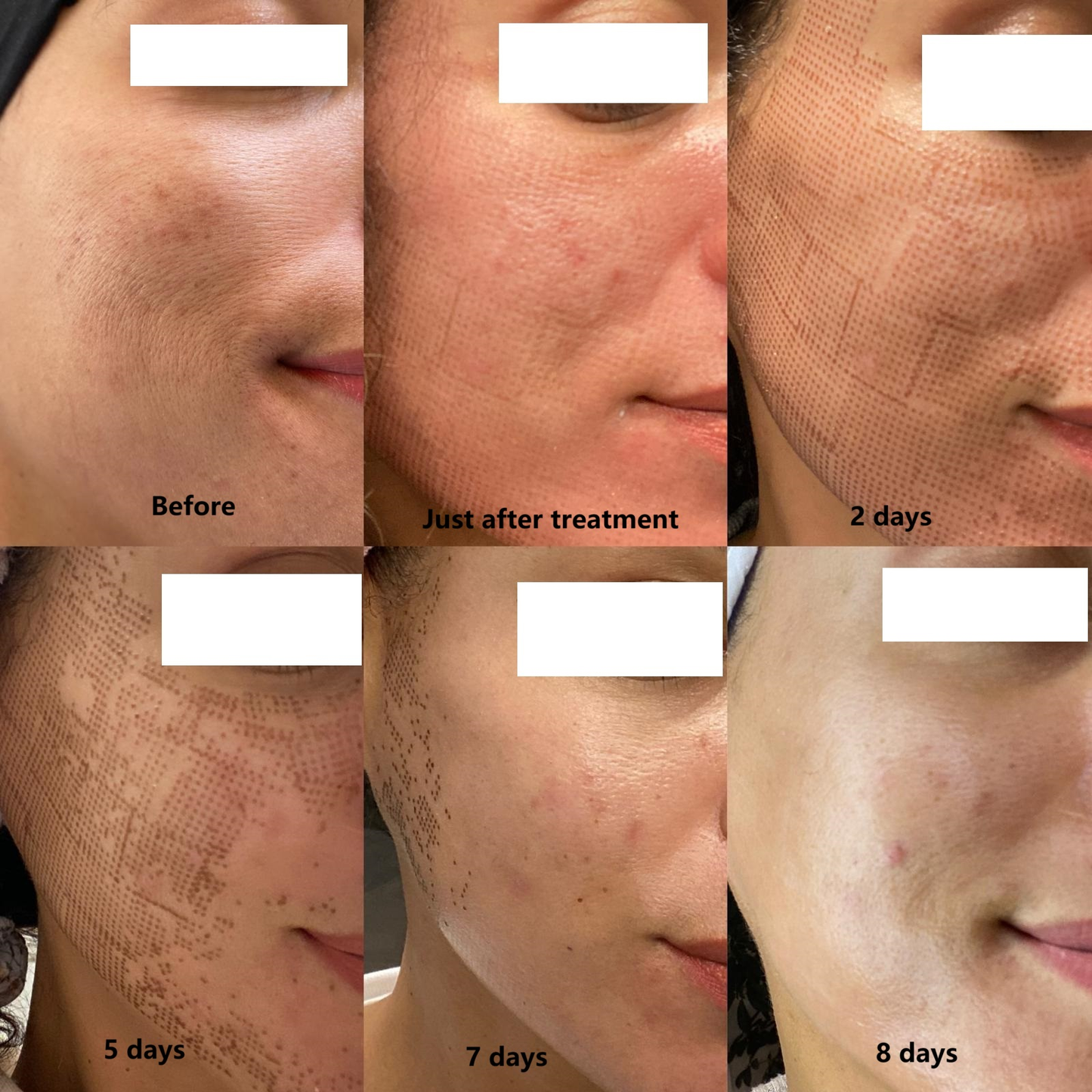 CarbonFrax™  Pro CO2 Fractional Laser