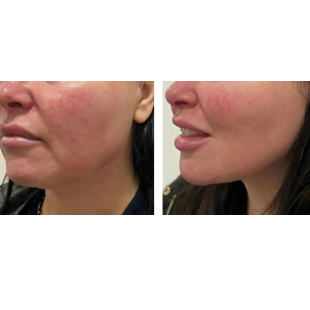 PERFECT FACE NEO 6D Complete