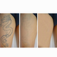 PicoElim Machine de Suppression de Tatouage au Laser Pico