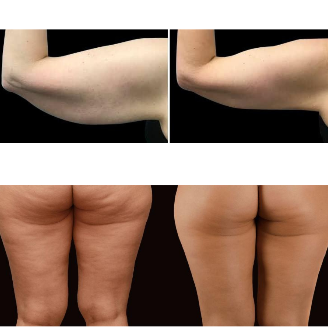 2026 Adonis™ II 30K Fat Blasting Cavitation Machine 6 in 1