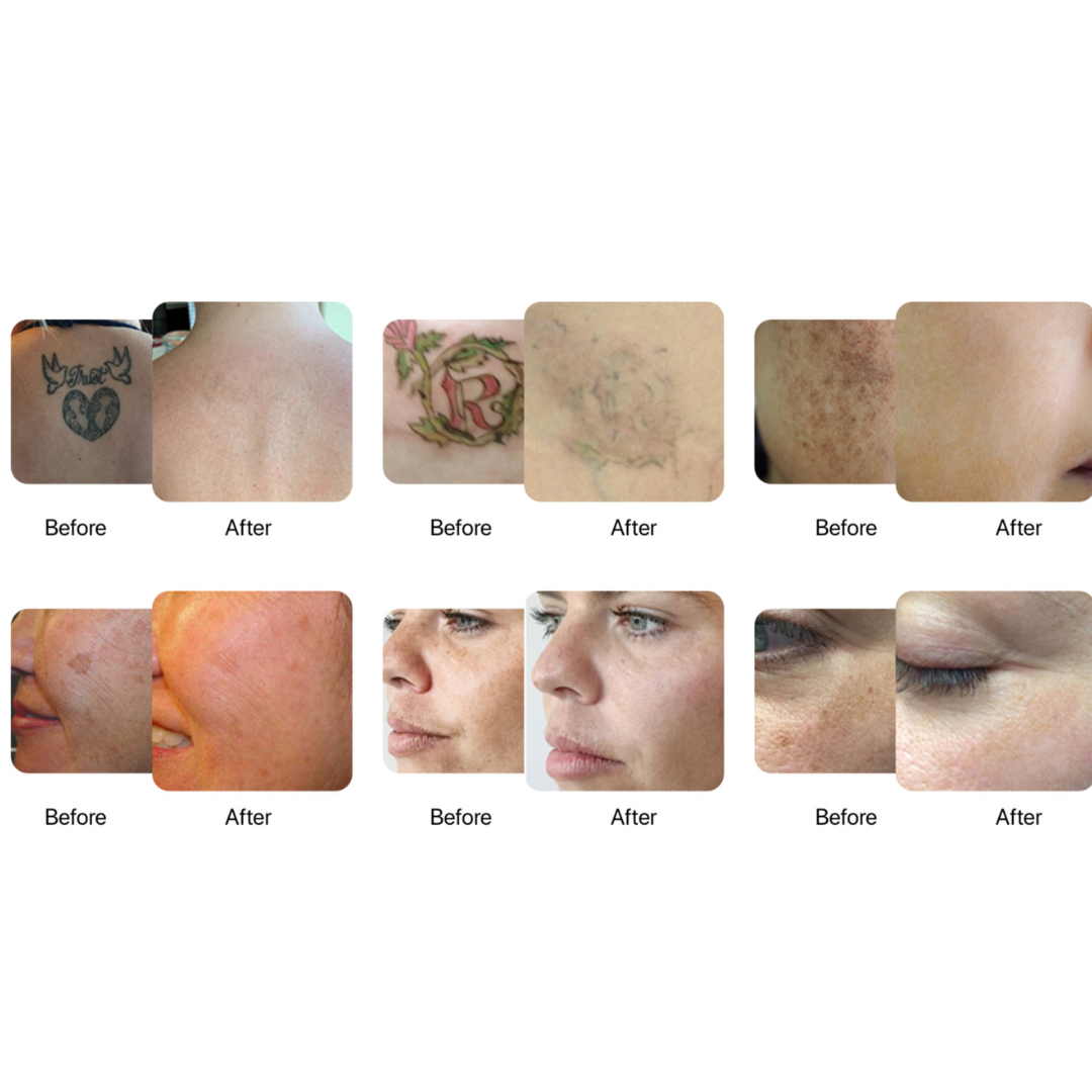 Machine à laser de suppression de tatouage Nano-Erase 4 Wave Dynamique