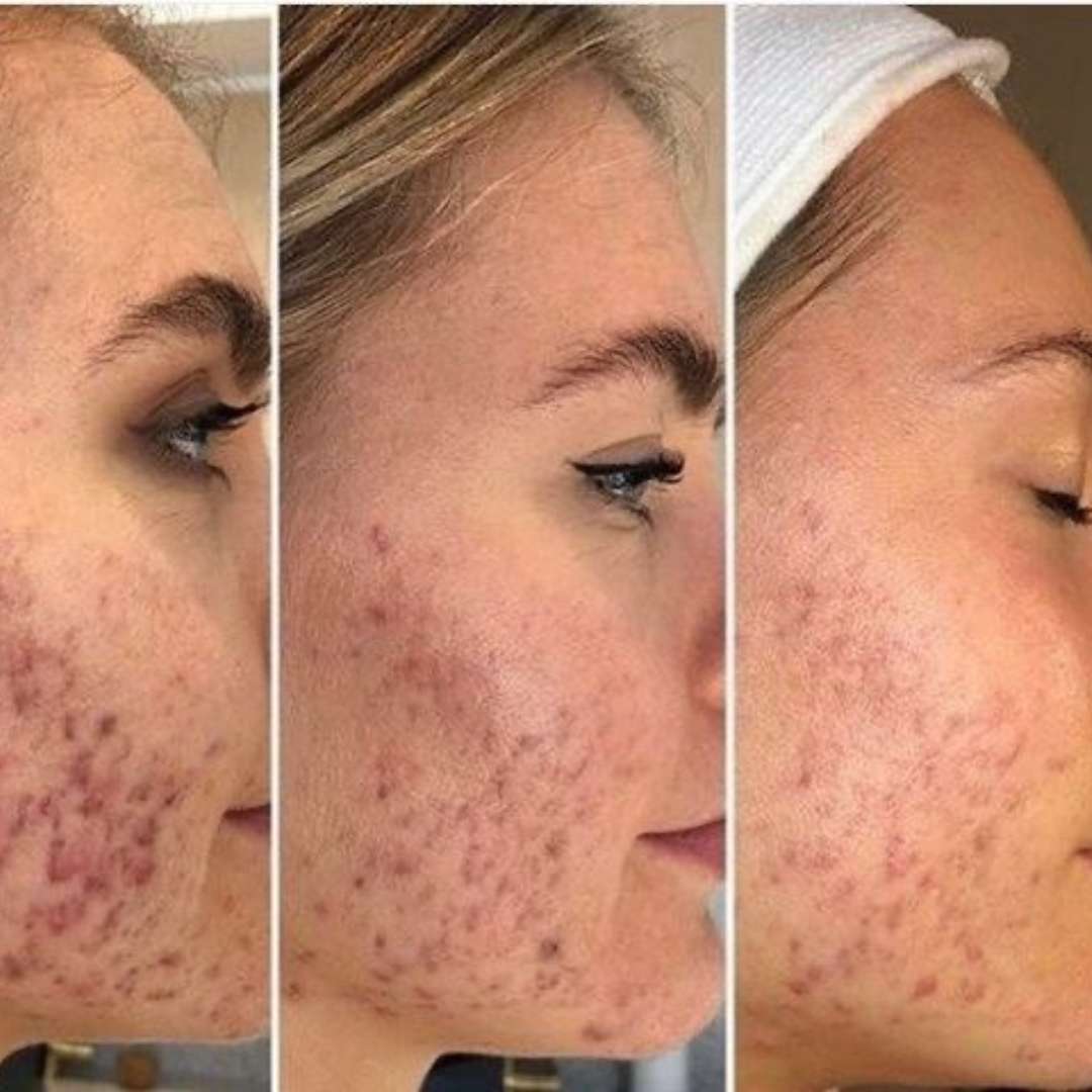 Pro-Secret™ Icy Gold RF Microneedling Machine