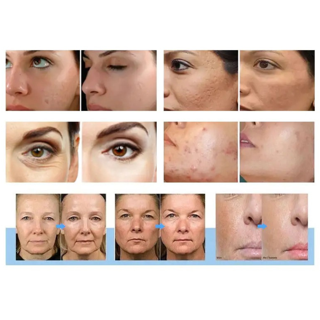 Metamorph8.5™ Golden Youth RF Microneedling Machine - Portable