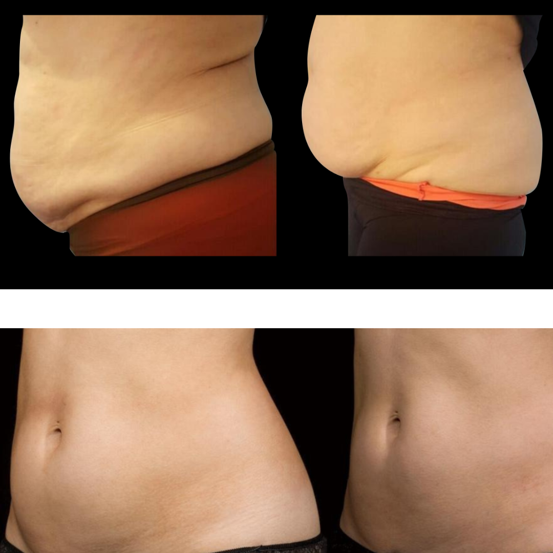 2026 Adonis™ II 30K Fat Blasting Cavitation Machine 6 in 1