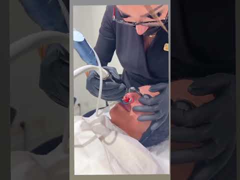 ReDerma™ Fractional CO2 Laser