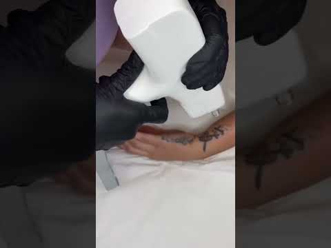 NDPlus Laser d'élimination de tatouage avec souffleur d'air froid